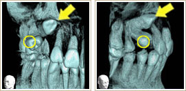 永久小臼歯の一部分が見えているCT写真1、2