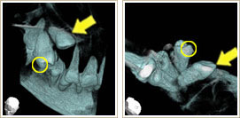 永久小臼歯の一部分が見えているCT写真3、4