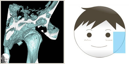 顎関節の正面右側を見たCT画像