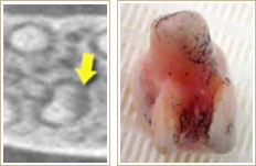 CT写真中、矢印で示す黒い影が根先病巣3