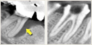 重度の歯周病のCT画像と健康な歯周組織のCT画像1