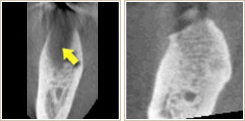 重度の歯周病のCT画像と健康な歯周組織のCT画像2