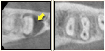 重度の歯周病のCT画像と健康な歯周組織のCT画像3