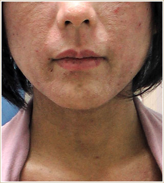 ノンメタル治療前　顔部分