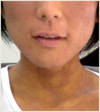 ノンメタル治療後　顔部分