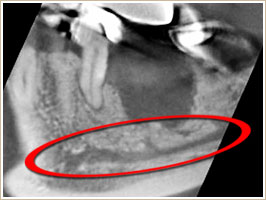 CTの断層レントゲン像（横方向からのスライス画像）