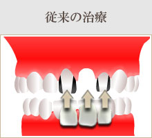 前歯一本欠損の場合　従来の治療。