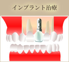 前歯一本欠損の場合　インプラント治療。