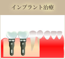 臼歯部から歯が欠損している場合(遊離端)　インプラント治療。