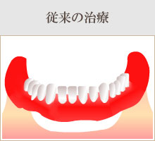 完全に歯がない場合　従来の治療。