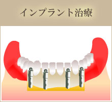 完全に歯がない場合　インプラント治療。
