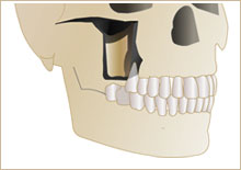 上顎骨の中に上顎洞（サイナス）構造イラスト2