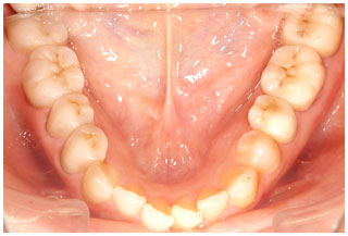 審美補綴治療後　下の奥歯