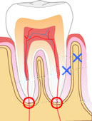 歯の構造のイラスト