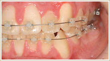 歯列を整えるためにワイヤーを用いた矯正　別角度2