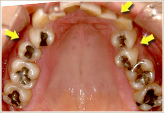 歯列が歪んでいる上顎からの写真　治療前