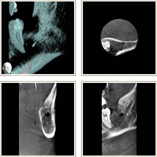抜歯後のＣＴ写真 例として4方向からのアプローチ写真