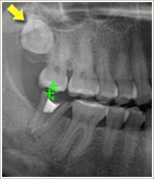 上顎の骨の中に埋伏した親不知の歯の写真　矢印で示しています