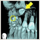 永久小臼歯の一部分が見えているCT写真1