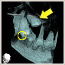 永久小臼歯の一部分が見えているCT写真3