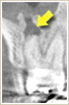 CT写真中、矢印で示す黒い影が根先病巣2