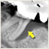 重度の歯周病のCT画像1