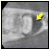 重度の歯周病のCT画像3