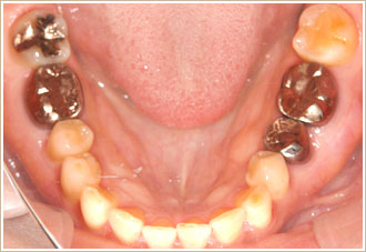 セレックシステム　下顎の治療前の写真