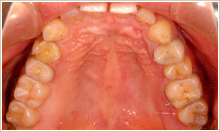 ノンメタル治療後　上顎