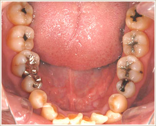 ノンメタル治療前　下顎