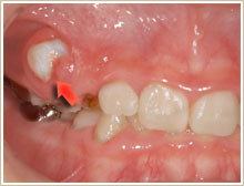 変な所から永久小臼歯が萌(は)えてきている写真