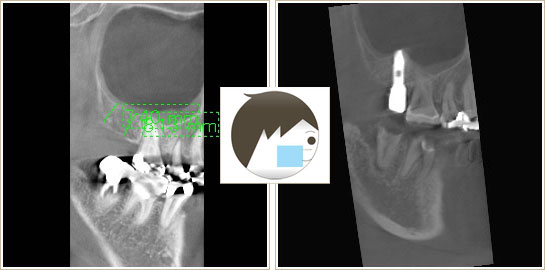 インプラント治療前と治療後のCT画像1
