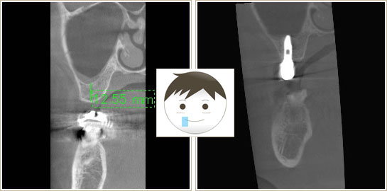 インプラント治療前と治療後のCT画像2