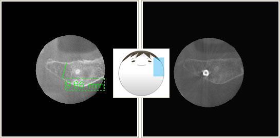 インプラント治療前と治療後のCT画像3