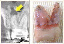 CT写真中、矢印で示す黒い影が根先病巣2