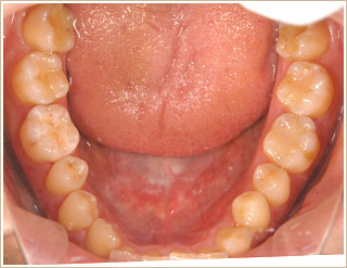 ノンメタル治療後　下顎