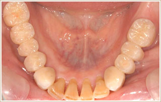 ノンメタル治療後　下顎