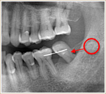 パノラマレントゲン写真 歯の移動を開始後1年