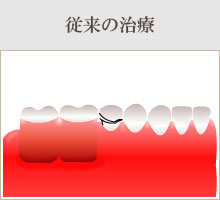 臼歯部から歯が欠損している場合(遊離端)　従来の治療。