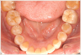 歯列が歪んでいる下顎からの写真　治療後