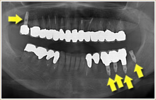 パノラマレントゲン写真　歯の抜けたところが分かる
