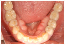 詰めものやクラウンを入れ変えたところ　下顎