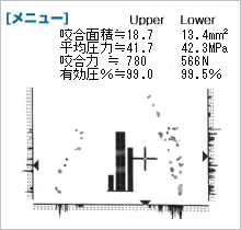 オクルーザーのデータ　噛み合わせ調整前