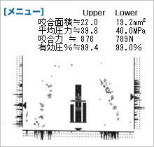 オクルーザーのデータ　噛み合わせ調整後