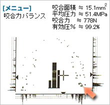 オクルーザーのデータ　噛み合わせ調整前