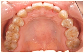 審美補綴治療後　上の奥歯