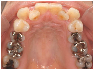クリアブラケットを用いた矯正　治療前　上顎