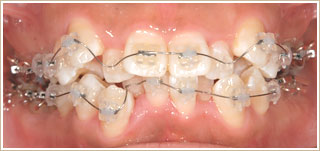 クリアブラケットを用いた矯正　スタート時　正面