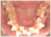 クリアブラケットを用いた矯正　スタート時　下顎