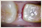 ２～３ヶ月で歯周組織が再生された写真